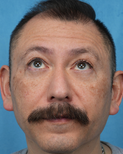Lower Blepharoplasty Before & After Patient #3736