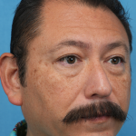 Lower Blepharoplasty Before & After Patient #3736
