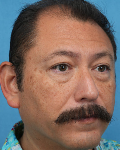 Lower Blepharoplasty Before & After Patient #3736