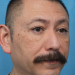 Lower Blepharoplasty Before & After Patient #3736