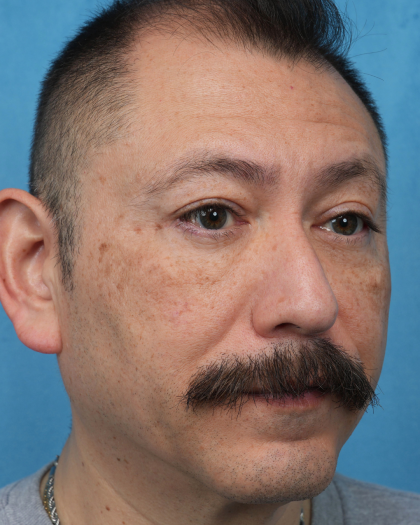 Lower Blepharoplasty Before & After Patient #3736