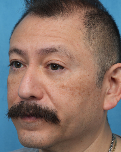 Lower Blepharoplasty Before & After Patient #3736