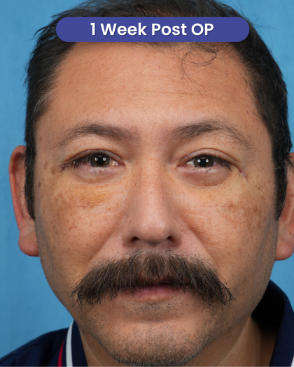 Lower Blepharoplasty Before & After Patient #3736