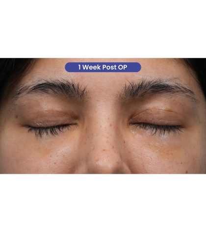 Lower Blepharoplasty Before & After Patient #3704
