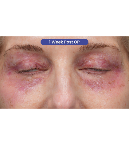 Upper Blepharoplasty Before & After Patient #3715