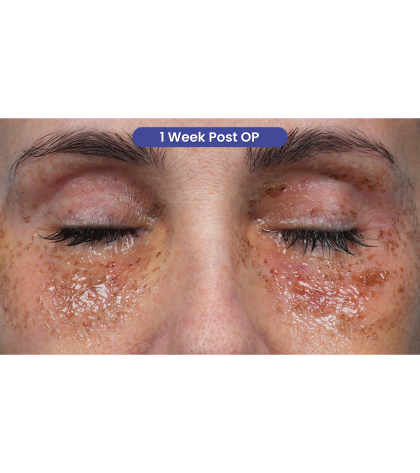 Lower Blepharoplasty Before & After Patient #3672