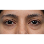 Lower Blepharoplasty Before & After Patient #3704