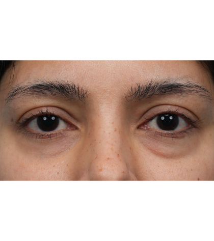 Lower Blepharoplasty Before & After Patient #3704