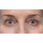 Upper Blepharoplasty Before & After Patient #3715