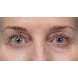 Upper Blepharoplasty Before & After Patient #3715