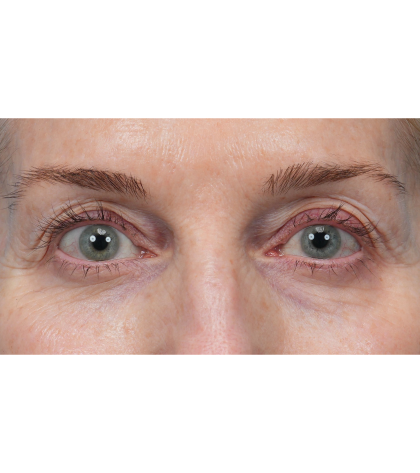 Upper Blepharoplasty Before & After Patient #3715