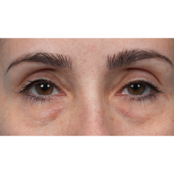 Lower Blepharoplasty Before & After Patient #3672