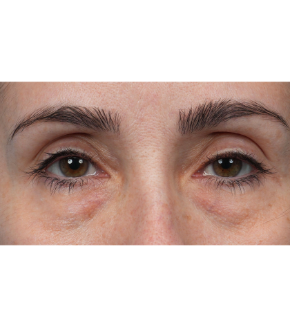 Lower Blepharoplasty Before & After Patient #3672