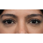 Lower Blepharoplasty Before & After Patient #3704