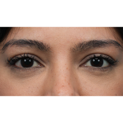 Lower Blepharoplasty Before & After Patient #3704