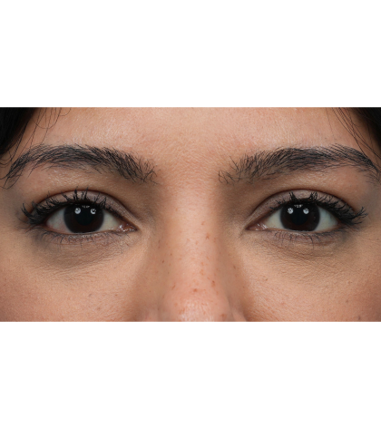 Lower Blepharoplasty Before & After Patient #3704