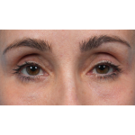 Lower Blepharoplasty Before & After Patient #3672