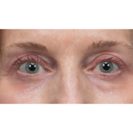 Upper Blepharoplasty Before & After Patient #3715