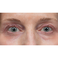 Upper Blepharoplasty Before & After Patient #3715