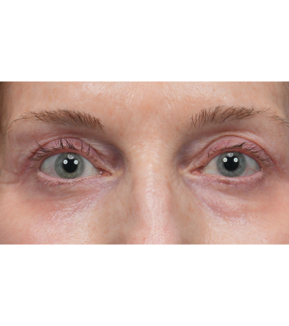 Upper Blepharoplasty Before & After Patient #3715