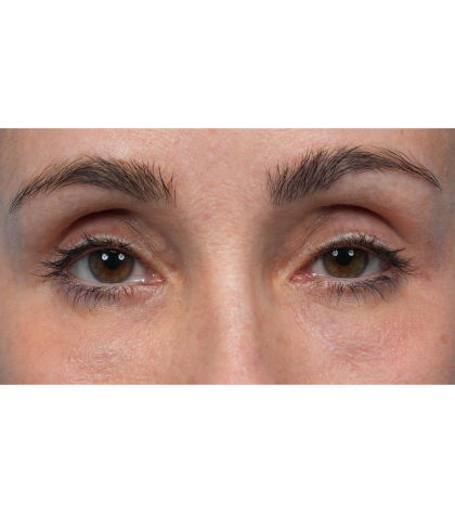 Lower Blepharoplasty Before & After Patient #3672