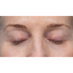 Upper Blepharoplasty Before & After Patient #3715