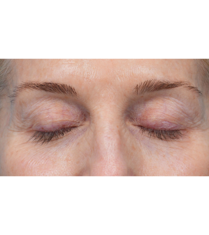Upper Blepharoplasty Before & After Patient #3715