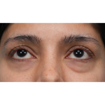 Lower Blepharoplasty Before & After Patient #3704
