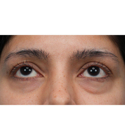 Lower Blepharoplasty Before & After Patient #3704