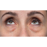 Lower Blepharoplasty Before & After Patient #3672