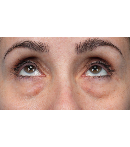 Lower Blepharoplasty Before & After Patient #3672