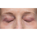 Upper Blepharoplasty Before & After Patient #3715