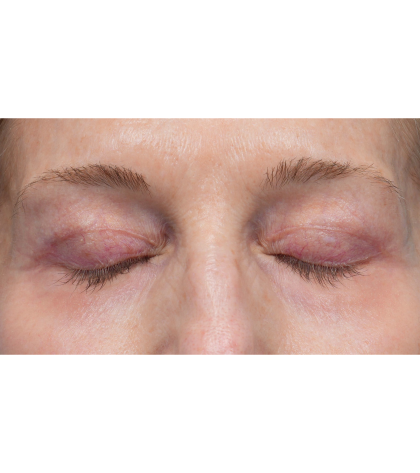 Upper Blepharoplasty Before & After Patient #3715