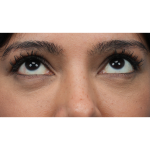 Lower Blepharoplasty Before & After Patient #3704