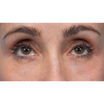 Lower Blepharoplasty Before & After Patient #3672