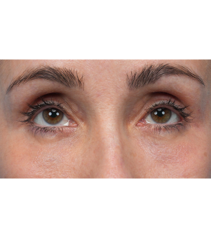 Lower Blepharoplasty Before & After Patient #3672
