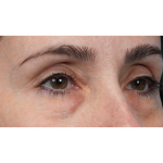 Lower Blepharoplasty Before & After Patient #3672