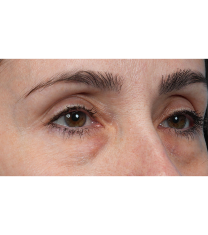 Lower Blepharoplasty Before & After Patient #3672