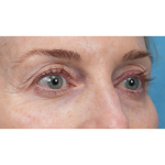 Upper Blepharoplasty Before & After Patient #3715