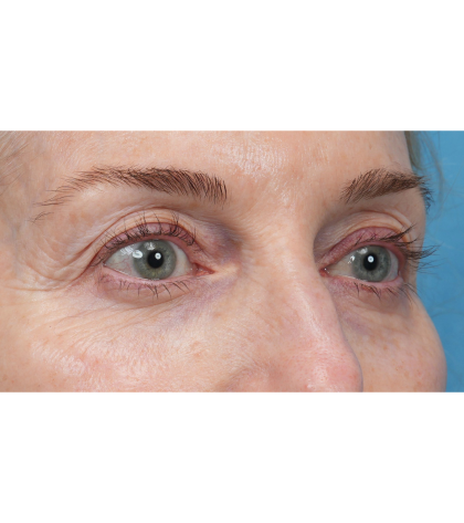 Upper Blepharoplasty Before & After Patient #3715