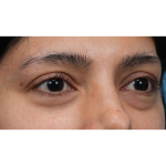 Lower Blepharoplasty Before & After Patient #3704