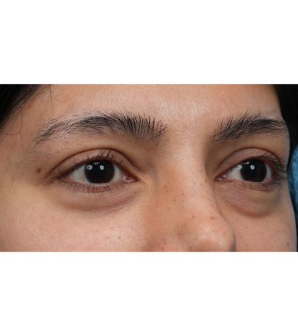 Lower Blepharoplasty Before & After Patient #3704
