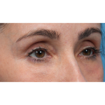 Lower Blepharoplasty Before & After Patient #3672