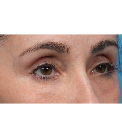 Lower Blepharoplasty Before & After Patient #3672