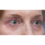 Upper Blepharoplasty Before & After Patient #3715