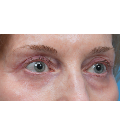 Upper Blepharoplasty Before & After Patient #3715