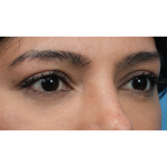 Lower Blepharoplasty Before & After Patient #3704