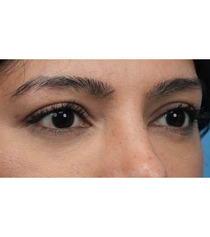 Lower Blepharoplasty Before & After Patient #3704