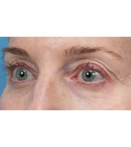 Upper Blepharoplasty Before & After Patient #3715