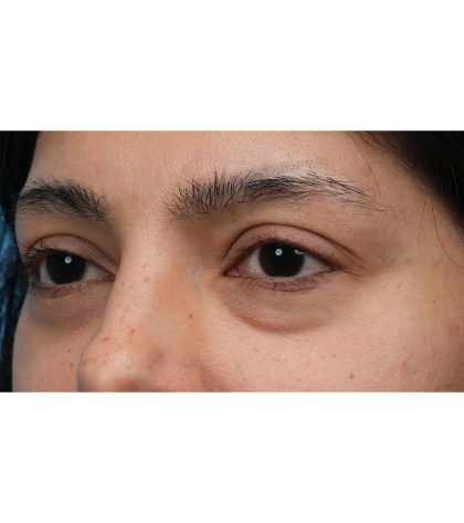 Lower Blepharoplasty Before & After Patient #3704